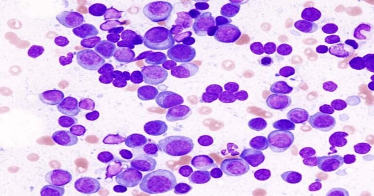 us multiple myeloma